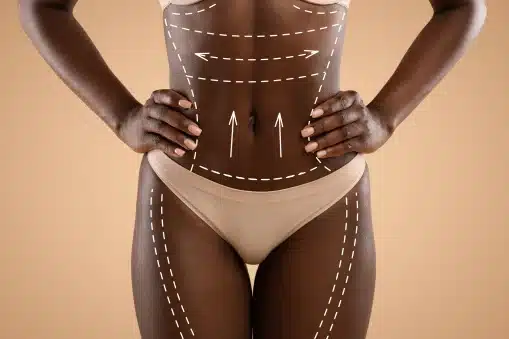 Body contouring trends