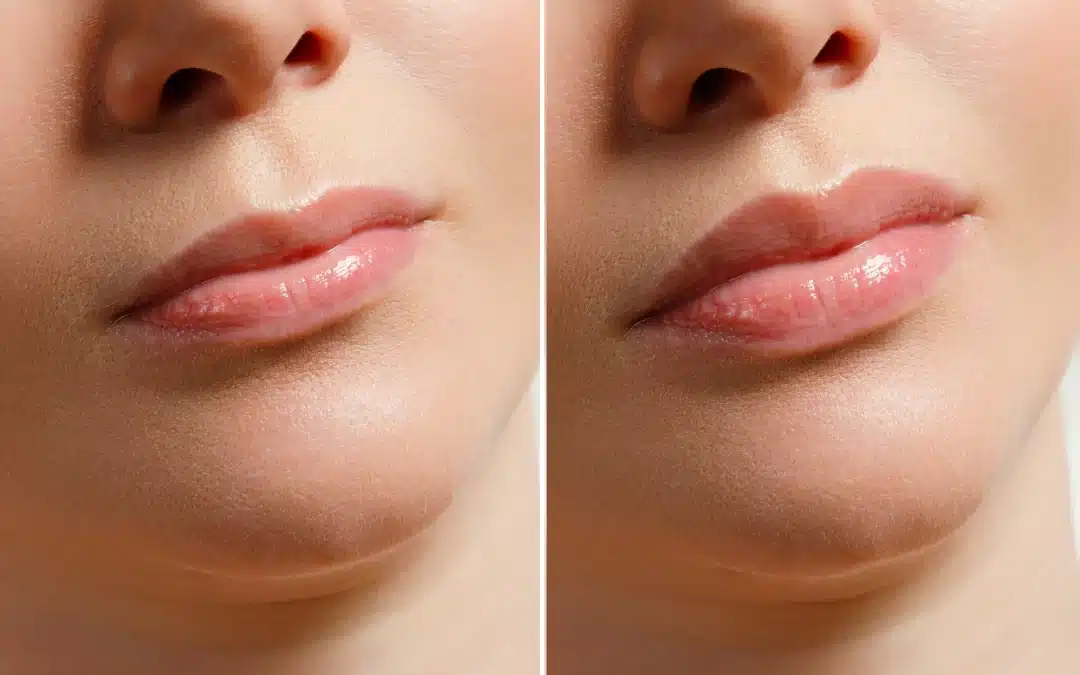 Dermal Fillers Before and After What to Expect