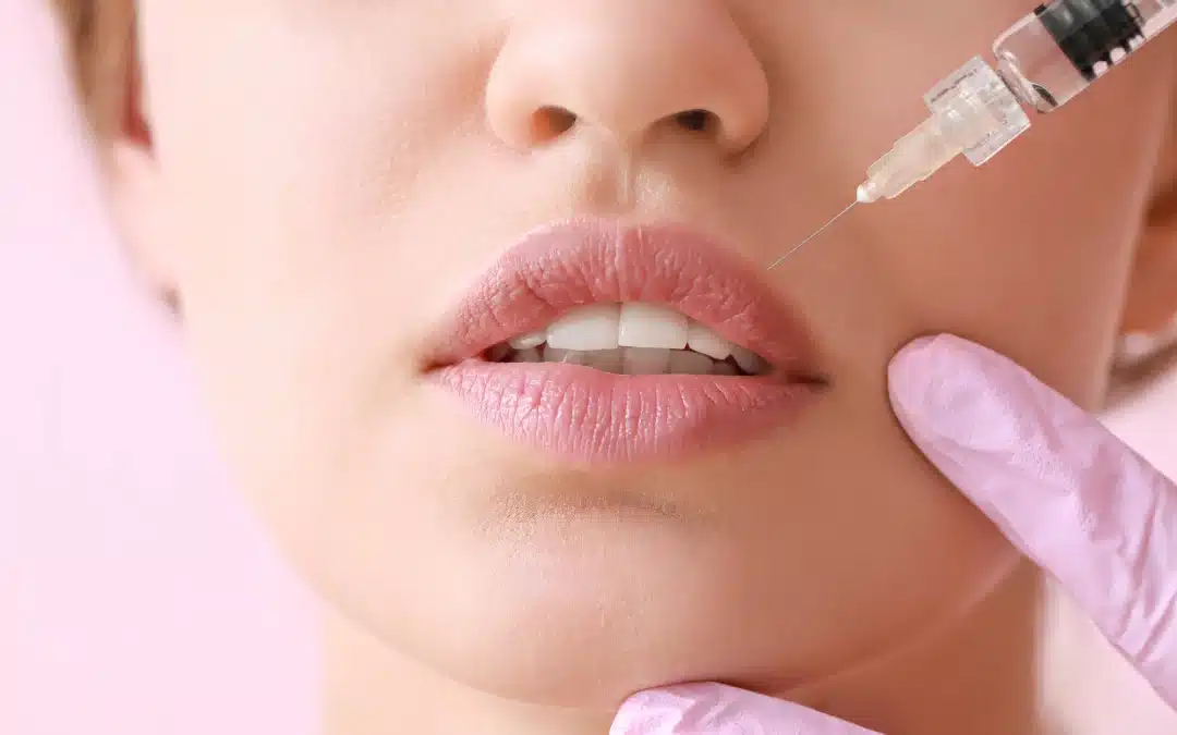 Understanding Lip Filler Swelling Stages: A Complete Guide