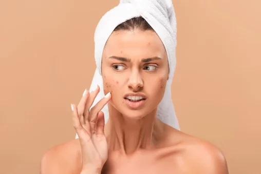 Comparison of Dermal Fillers for Acne Scarring