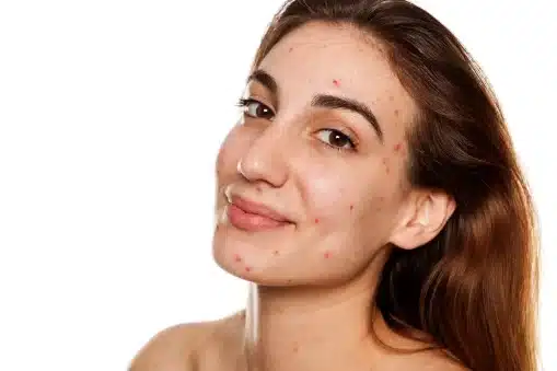 Dermal Fillers for Acne Scarring Which Products Deliver the Best Results