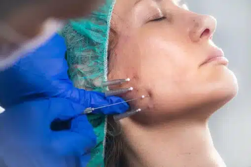 Thread Lift Recovery & Aftercare Immediate Post Procedure Care (First 24–48 Hours)